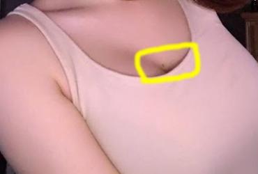 10 Nốt Ruồi Khiến Bạn Lo Lắng Nhất