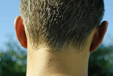 Nốt Ruồi Ở Sau Gáy Có Ý Nghĩa Gì?