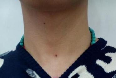 Nốt Ruồi Ở Trước Cổ Đàn Ông Có Ý Nghĩa Gì?