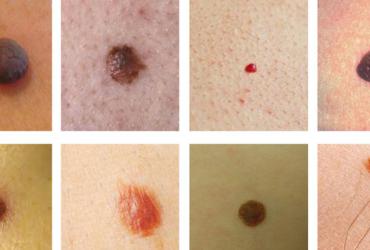 Cách Phân Biệt Nốt Ruồi Tốt hay Xấu Đơn Giản