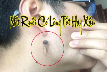 Nốt Ruồi Có Lông Tốt Hay Xấu?