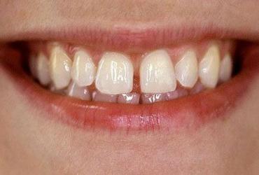 Bật mí thú vị về người có răng cửa thưa